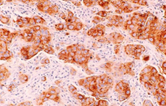 团队确定某些免疫细胞如何导致 HER2 阳性乳腺癌患者的存活率降低