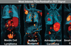 新型 PET 试剂可有效检测多种癌症 识别患者以进行靶向治疗