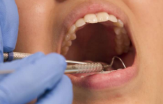 牙龈疾病 动脉硬化可能与中风风险有关
